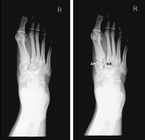 Figure From A Lisfranc Fracture Dislocation In A Football Player