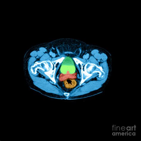 Ct Of Enlarged Prostate Photograph by Medical Body Scans