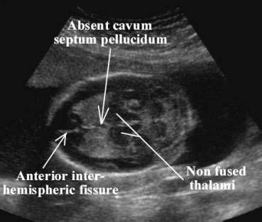 Holoprosencephaly On Ultrasound