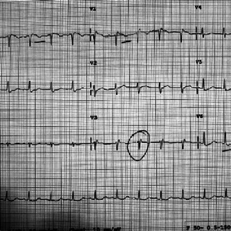 Ecg Showing Right Heart Load As A Result Of Pulmonary Embolism Fig 4