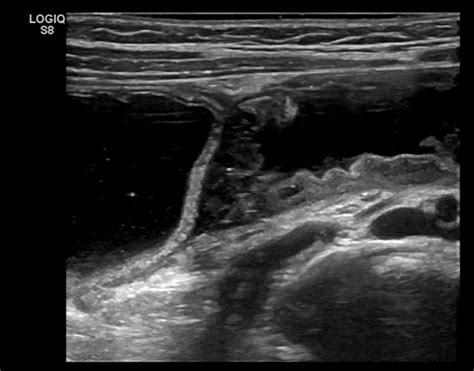 Ultrasound exam. Successful reposition is confirmed when saline is seen... | Download Scientific ...