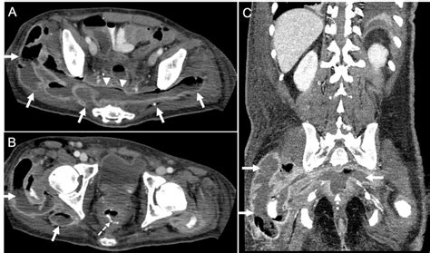 The Contrast Enhanced Abdominal Computed Tomography Ct Images In