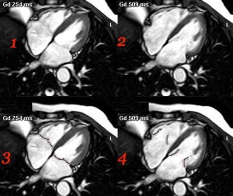 Cardiac MRI Anatomy