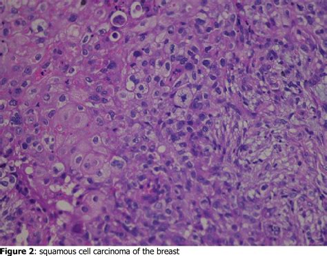 Figure 1 From Primary Squamous Cell Carcinoma Of The Breast A Case