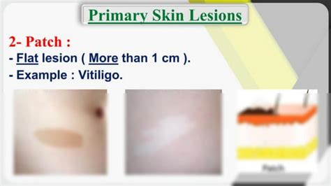 Solution Primary Skin Lesions Studypool