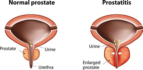 Enlarged Prostate Specialist - Beverly Hills, CA & Encino, CA: LA ...