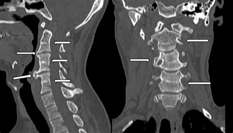 Computed Tomography Showing A Block Of C2C3 C4C5 And C6C7 Vertebral