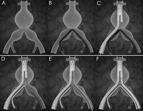 Crossover Chimney Technique To Preserve The Internal Iliac Artery