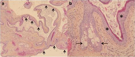 Histopathological Features Hande Stain Of The Dermoid Cyst A Low