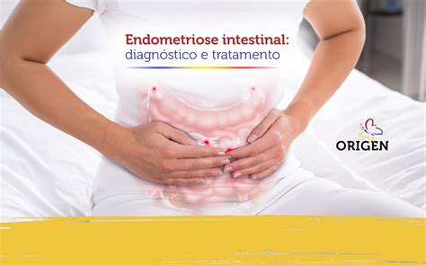 Endometriose Intestinal Diagn Stico E Tratamento Cl Nica Origen