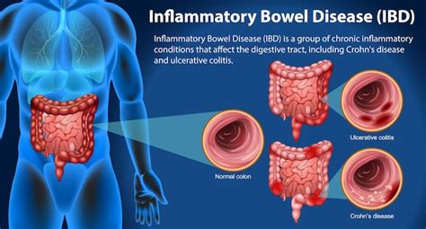 Premium Vector Inflammatory Bowel Disease Ibd Infographic