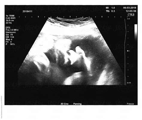 36 Weeks Pregnant Ultrasound