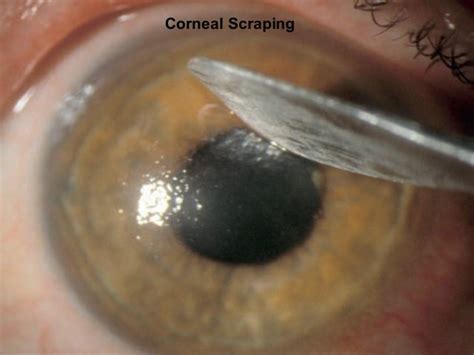 Corneal Ulcer