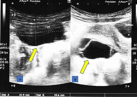 Ultrasound scan image of a 3.3 cm × 2.1 cm × 2.5 cm sized complex cyst... | Download Scientific ...