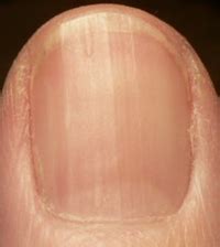 Ridges on fingernails vitamin deficiency - Awesome Nail