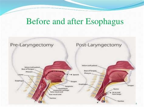 Esophageal Speech Recognition Using Artificial Neural Network Ann