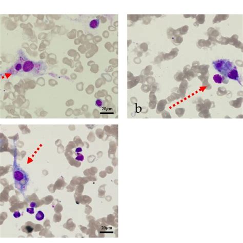 Image Of Bone Marrow Aspiration A Phagocytic Neutrophils B Download Scientific Diagram