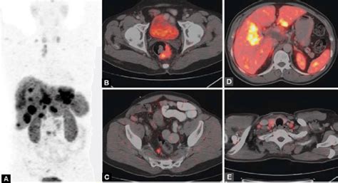 A To E Ga 68 DOTATATE PET CT Images Of A 55 Years Old Male Patient