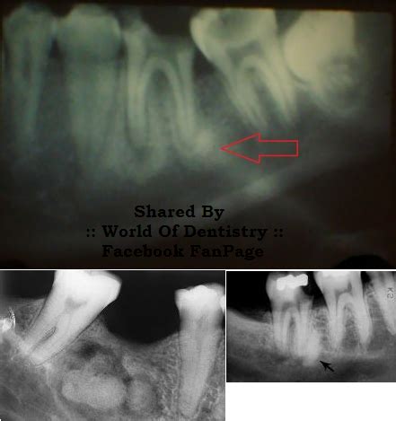 :: World Of Dentistry ::: Condensing Osteitis