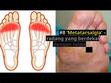 Sakit Telapak Kaki Newstempo