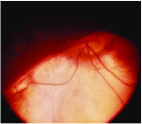 Fundus Photograph With Choroidal Coloboma Normal Looking Optic Disc Download Scientific