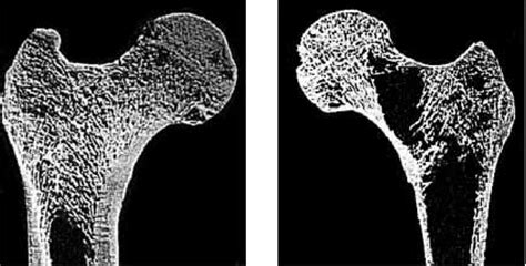 Left Femoral Neck Osteoporosis