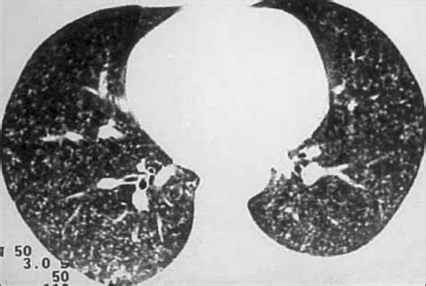 Chest Ct Scan Revealing Multiple Micronodules At The Lung Parenchyma