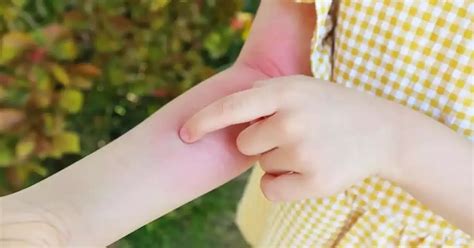 Qué Es La Dermatitis Atópica Una Enfermedad Que Afecta A Un 30 De Niños Y Adolescentes