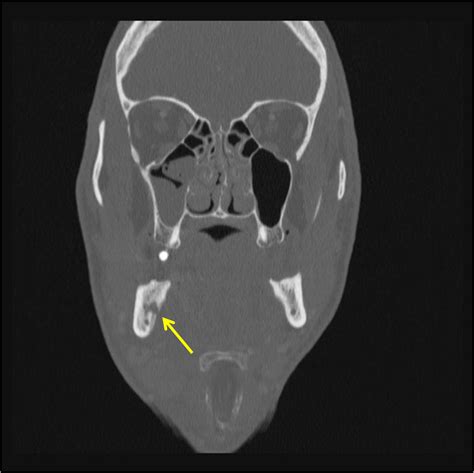 Submandibular Space Abscess Radiologypics