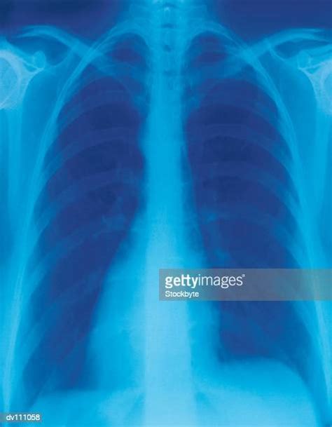 1 456 X Ray X Ray Image Chest Stock Photos High Res Pictures And