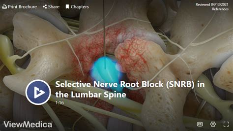 Selective Nerve Root Block in Knoxville - Omega Pain Management