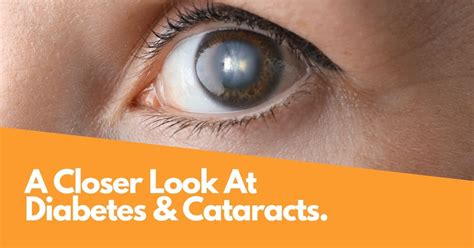 Stonewire Optometry Edmontons Eye Care Blog Diabetes Eye Exams And