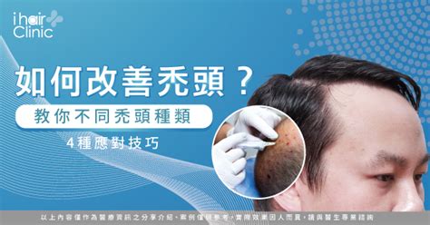 女性雄性禿怎麼辦4個qa4個改善方法帶你看 Ihair風華御髮