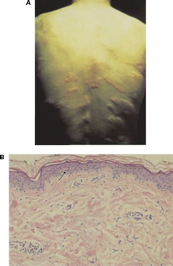 Hypersensitivity Type Iv Oncohema Key