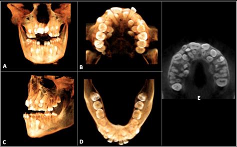 Cleidocranial Dysplasia Intraoral