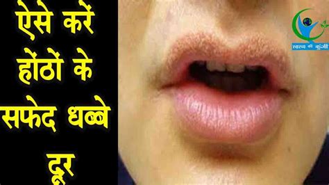 white spots  lips treatment  hindi lipstutorialorg