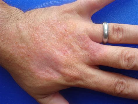 Contact Dermatitis Wrist