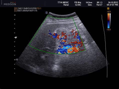 Gallbladder Cancer Ultrasound