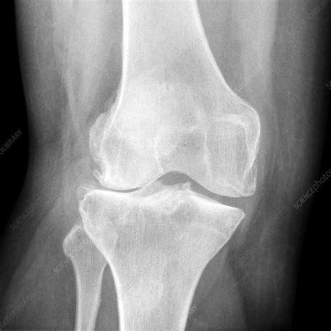 Osteophytes Knee