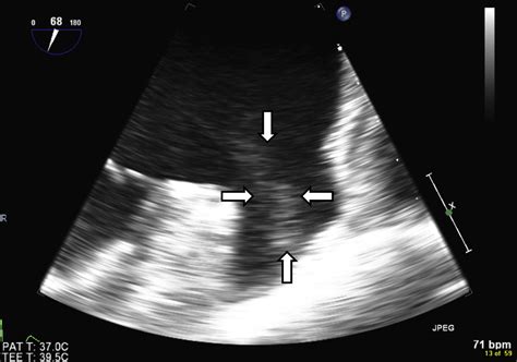 Left Atrial Thrombus And Dense Spontaneous Echocardiographic Contrast