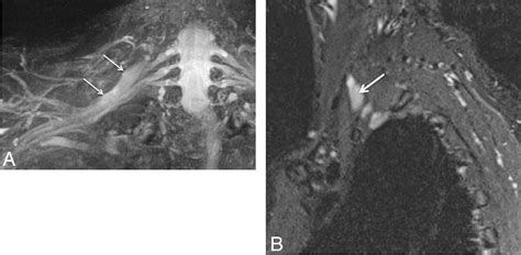 Figure 1 From High Resolution 3T MR Neurography Of The Brachial Plexus