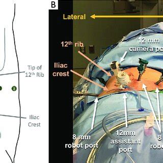 Port Placement For Retroperitoneoscopic Robotic Partial Nephrectomy