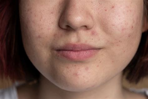 6 Effective And Proven Acne Scar Treatment In Singapore