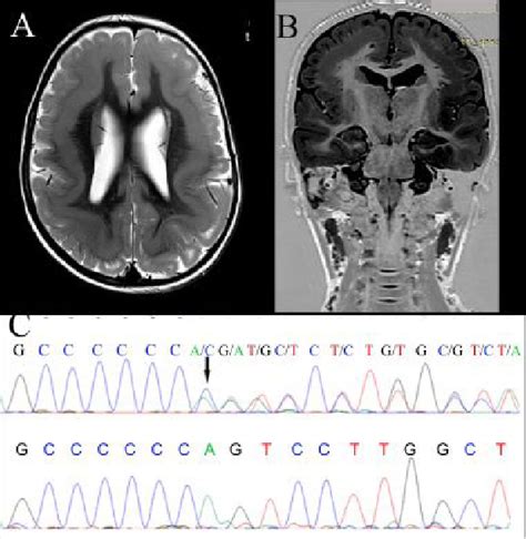 Brain Imaging And Genetic Data Of The Patient Brain Mri Showing Thick