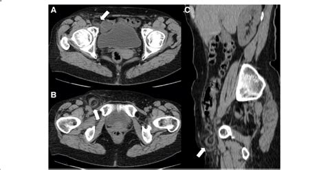 Acute Epiploic Appendagitis In A 59 Year Old Woman Axial Non Contrast