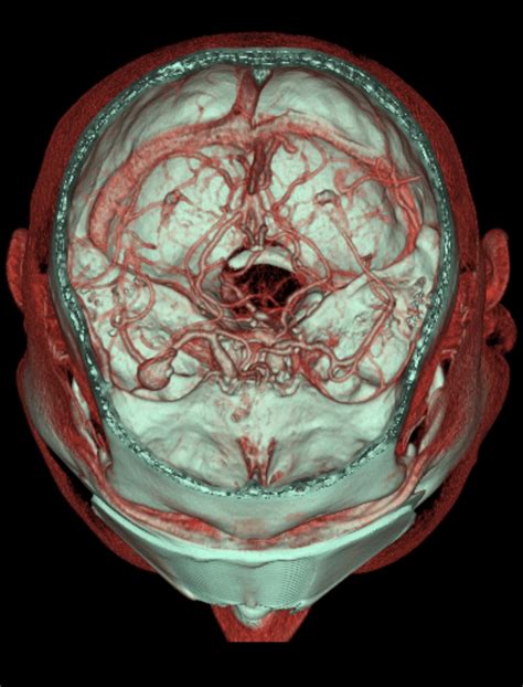 MCA Trifurcation Aneurysm CTA Image Radiopaedia Org