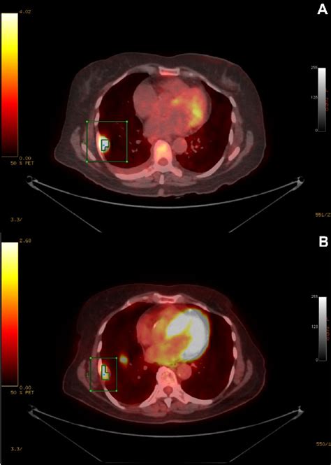 Figure 1 From Durable Response Using Regorafenib In An Elderly Patient