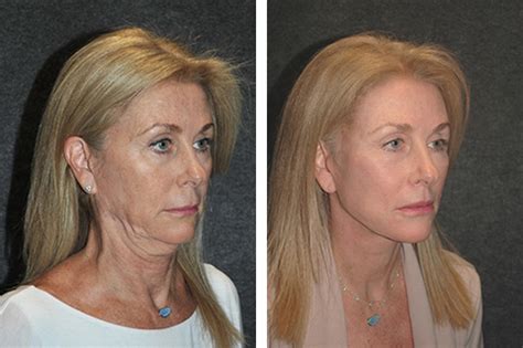 Deep Plane Facelift Deep Plane Facelifting Dr Andrew Jacono