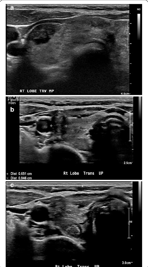 Multiple Transverse B Mode Ultrasound Images Obtained By Linear Probe