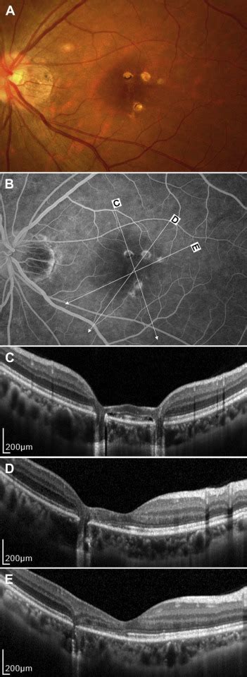 Spectral Domain Optical Coherence Tomographic Findings At Each Stage Of Punctate Inner